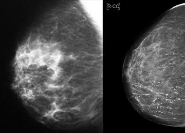 Рак грудей 4 стадії з метастазами: скільки живуть люди і як виглядає на фото