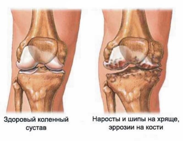 Гемартроз: що це таке, симптоми гемартроза колінного суглоба, лікування