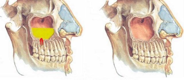 Одонтогенний гайморит (синусит) через хворого зуба: симптоми і лікування