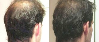 Плазмотерапія для особи і для волосся: що це таке, переваги процедури плазмотерапіі