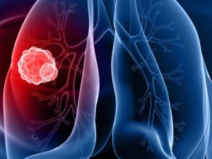 Лікування раку легенів і правила харчування при раку легенів, методи профілактики раку легенів
