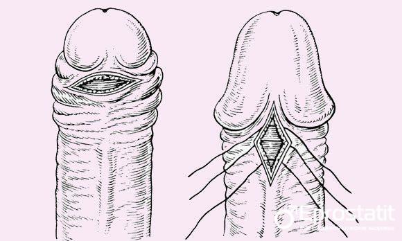 Підрізати вуздечку крайньої плоті статевого члена у чоловіків - коротка вуздечка