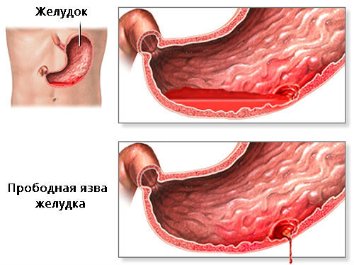 Перфорація шлунка: симптоми, лікування, наслідки та прогнози