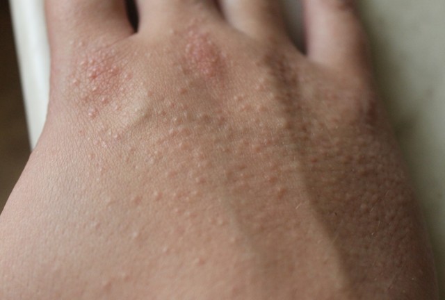 Роздратування на шкірі рук: від миючих засобів, холоду, на пальцях