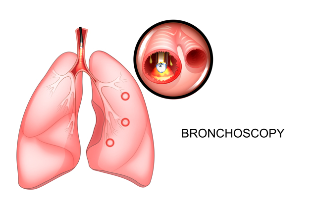 Бронхоскопія легких: що це таке, як роблять, підготовка до бронхоскопії