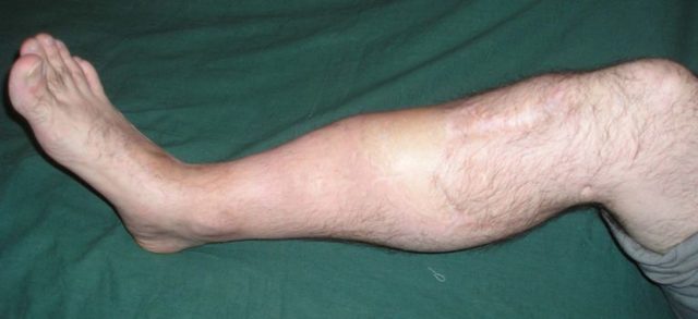 Помилковий суглоб після перелому: лікування, операція, причини формування помилкового суглоба