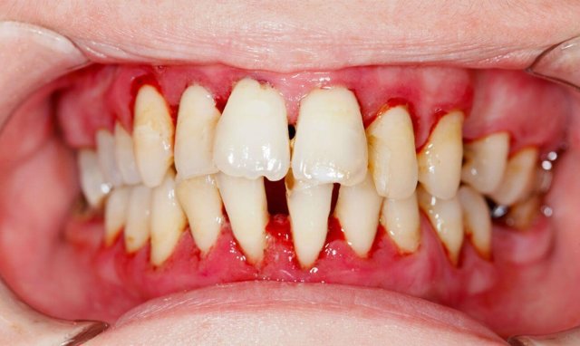 Набряк ясна біля зуба: як зняти, лікування, ніж полоскати в домашніх умовах