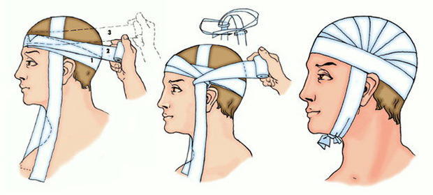 Перша допомога при пораненні голови: пов'язка, обробка рани при пораненні волосистої частини голови