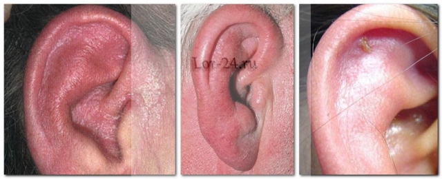 Бешиха вуха: причини, симптоми і лікування