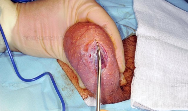 Сперматоцеле: лікування кісти придатка яєчка у чоловіків, операція при сперматоцеле