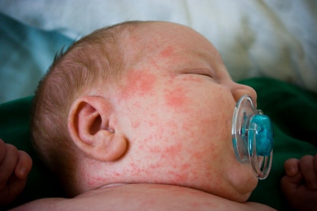 Алергічний дерматит у дітей: фото, симптоми і лікування