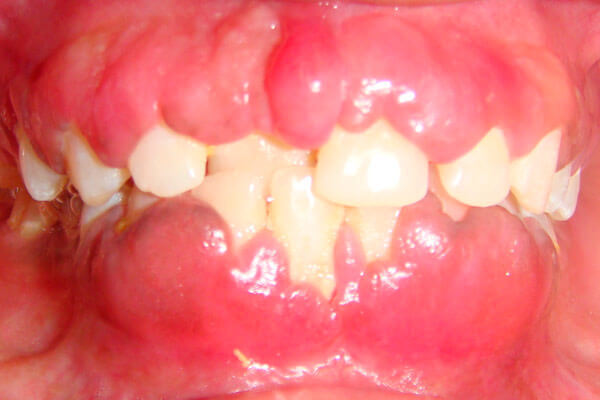 Опухла щока, але зуб не болить: як зняти пухлина, що це може бути, що робити