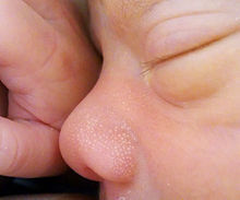 Вроджена аплазія шкіри волосистої частини голови у новонароджених: симптоми, лікування