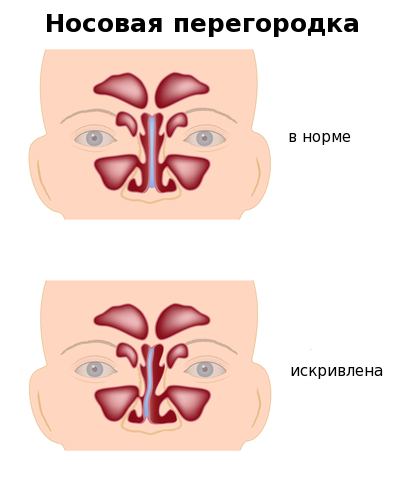 Перфорація носової перегородки: симптоми і лікування з операцією і без