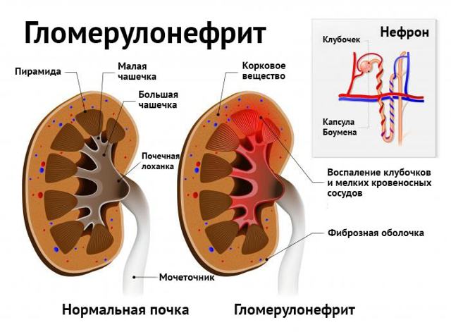Гломерулонефрит: симптоми, форми, причини, діагностика, методи лікування гломерулонефриту і ускладнення даного захворювання