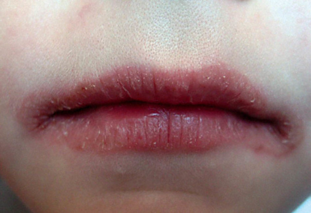 Заїди в куточках рота: причини, лікування, як вилікувати заїди у дорослого і у дитини