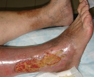 Посттромбофлебітична хвороба вен нижніх кінцівок: симптоми, лікування