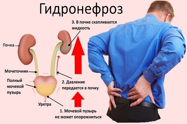 Стриктура уретри: симптоми і лікування звуження сечівника у чоловіків і жінок