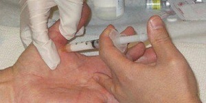 Стенозуючий лігаментит, блокування великого пальця: лікування