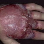Гангренозна піодермія на руках і ногах: що це, фото, симптоми, лікування