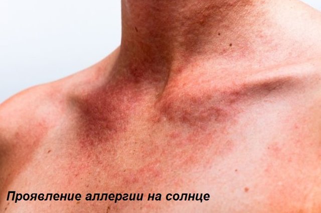 Чому з'являються червоні сверблячі плями на тілі?