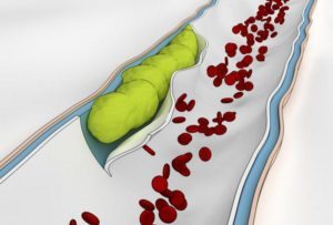 Тромбоз кишечника: причини виникнення та методи лікування