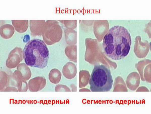 Пельгеровская аномалія нейтрофілів (лейкоцитів)