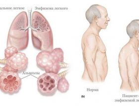 Емфізема легенів: симптоми і причини захворювання дихальних шляхів