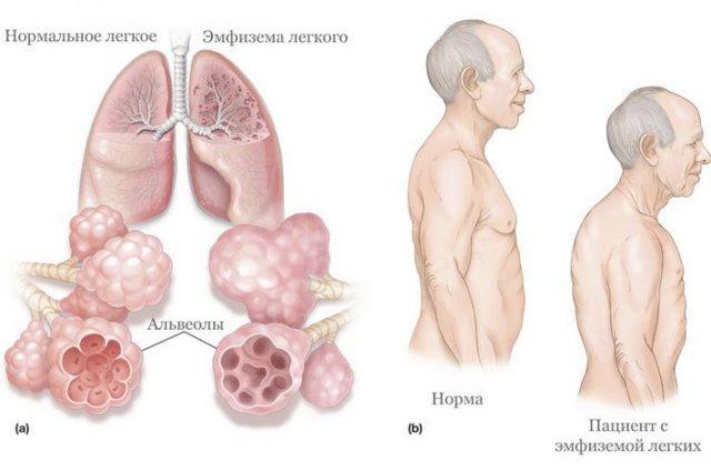 Емфізема легенів: симптоми і причини захворювання дихальних шляхів