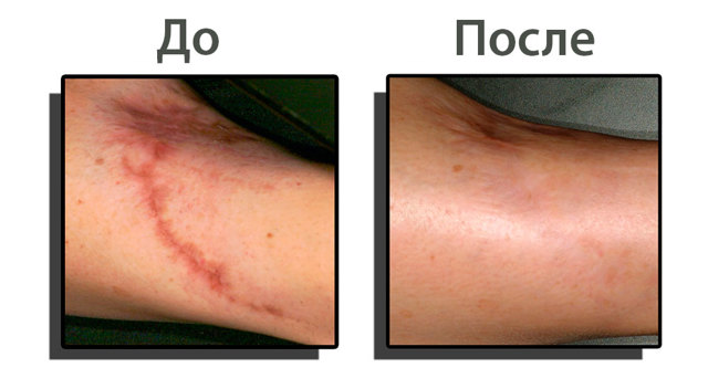 Лікування рубців, як прибрати рубці на шкірі, видалення рубців і шрамів