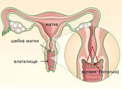 Як лікувати молочницю, якщо нічого не допомагає?