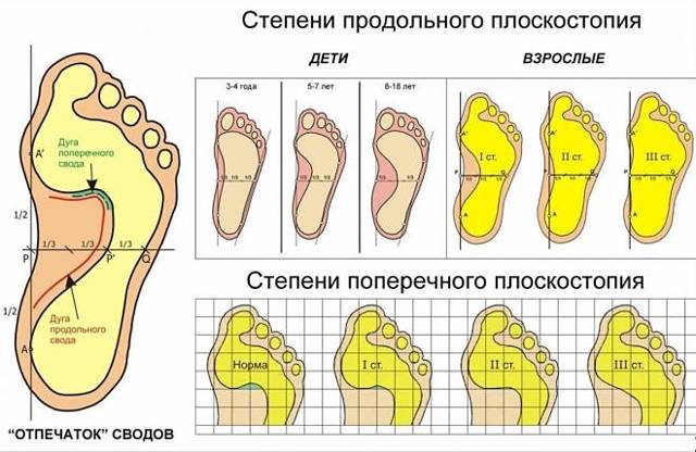 Порожня стопа: що це таке, симптоми і лікування, чи можлива служба в армії