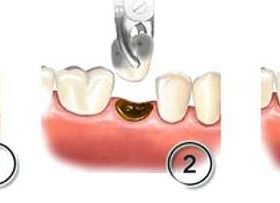 Ускладнення після видалення зуба: суха лунка, запальні процеси, медичний контроль і лікування