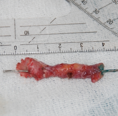 Операції при вроджених свищах і кістах шиї: опис і види