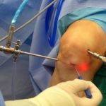 Гіалуронова кислота для суглобів: огляд препаратів для лікування, уколи в коліно
