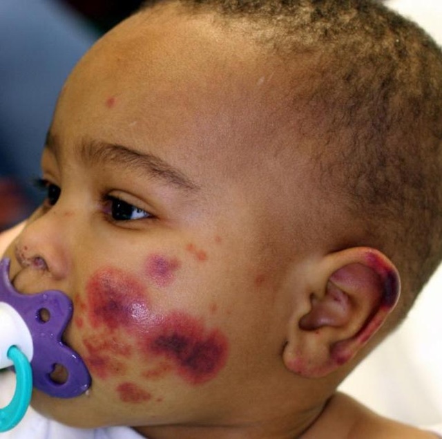 Чому тромбоцити знижені у дитини: основні причини низького показника