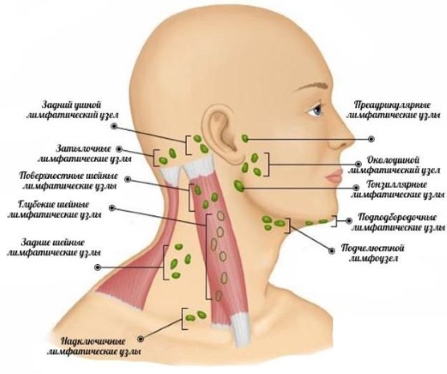 Запалення лімфовузлів на шиї: причини, симптоми і лікування