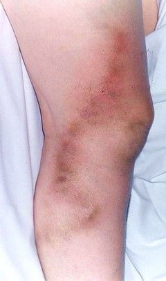 Як проявляється тромбоз і варикоз вен на ногах і руках