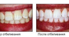 Відбілювання зубів opalescence boost, домашнє відбілювання зубів з капами: що це