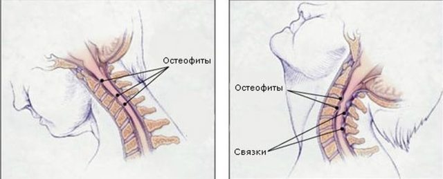 Від чого виникає сильний головний біль в районі маківки?