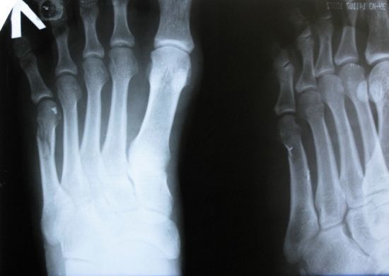 Перелом плеснової кістки стопи: скільки заживає у дорослих, скільки ходити в гіпсі, лікування