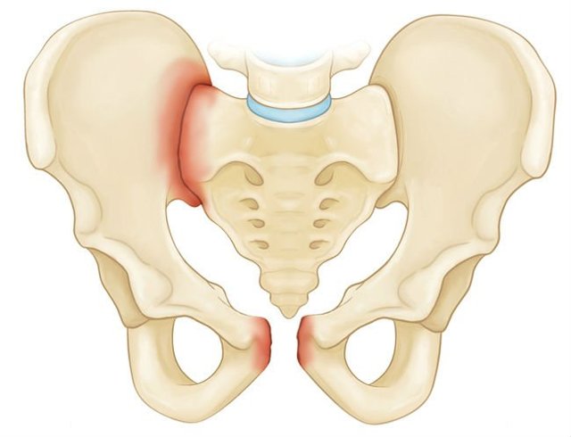 Перелом кісток тазу: невідкладна допомога, наслідки, скільки триває лікування