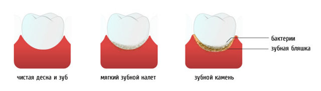 Дентамет Гель стоматологічний: інструкція із застосування, склад, аналоги