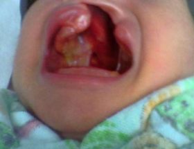Заяча губа: причини виникнення, що робити, фото до і після операції