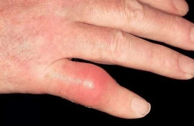 Болять пальці рук: що робити: причини і лікування болю в суглобах пальців рук