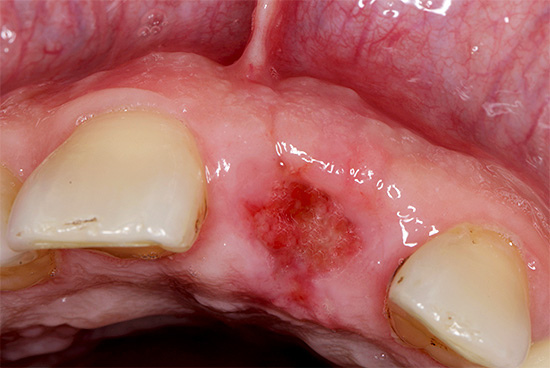 Альвеолит після видалення зуба: симптоми, фото і лікування