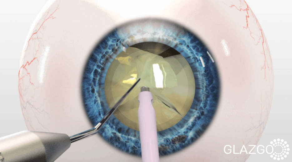 методы лечения катаракты