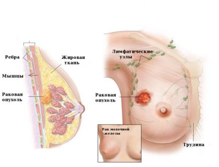 Рак молочної залози: діагностика та лікування